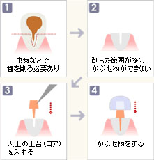 かぶせ物の土台について